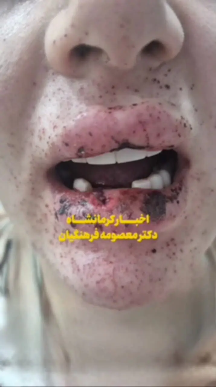 شلیک پدرشوهر به دهان عروس؛ شرح وضعیت مصدوم از زبان پزشک