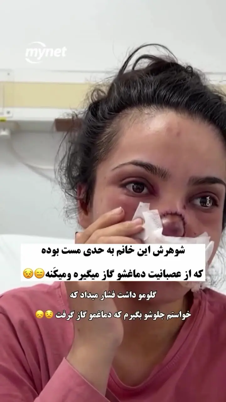 گاز گرفتن بینی زن توسط شوهر مست؛ پایان تلخ یک درگیری خانوادگی